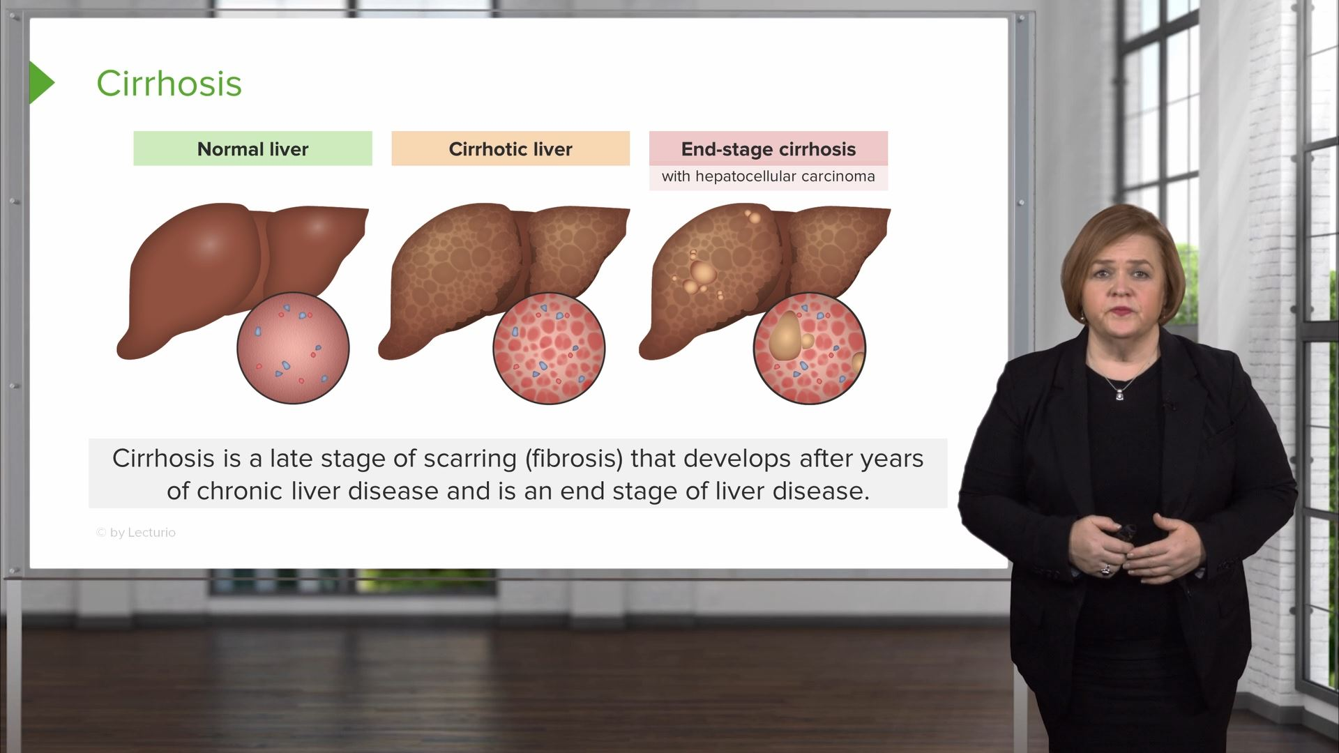 Liver Cirrhosis – Med-Surg Nursing | Lecturio