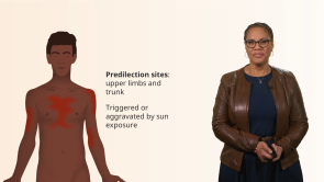 Connective Tissue Diseases in Patients with Darker Skin
