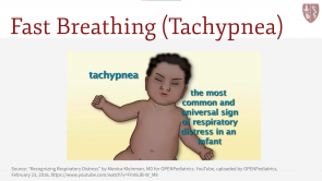 Diagnosis of Pediatric Respiratory Distress