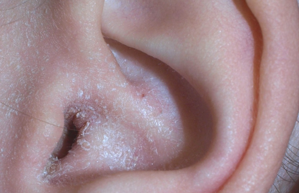 Gehörgangsentzündung_Ohr_Eczema_ear2.jpg