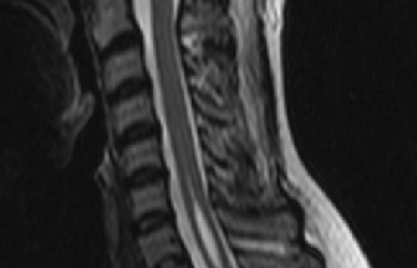 syringomyelie-Höhlenbildung-Rückenmark-Syringomyelia.jpg