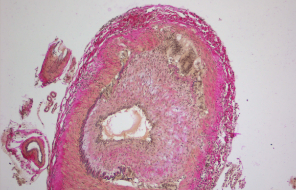 Arteritis-temporalis-Entzündung-Cerebral_Giant-Cell_Vasculitis.jpg