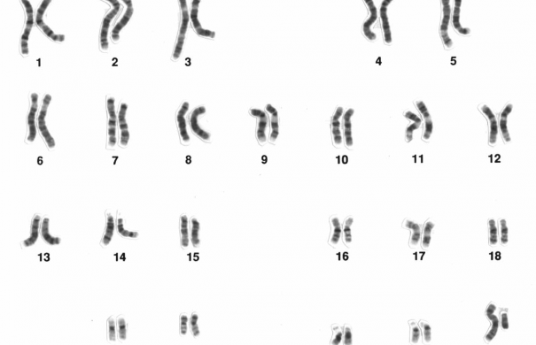 Chromosomenaberration_Human_male_karyotpe_high_resolution.jpg