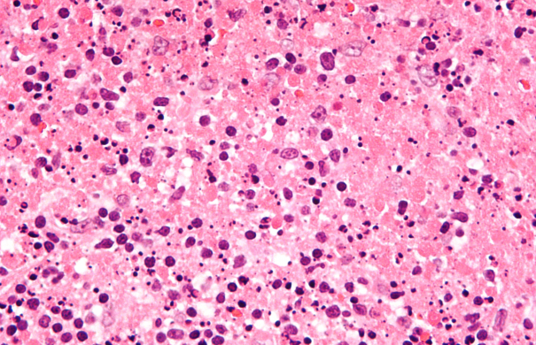 Histiocytic_necrotizing_lymphadenitis_-_very_high_mag.jpg