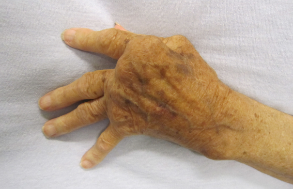 Rheuma_Hand_4096px-Rheumatoid_Arthritis.JPG