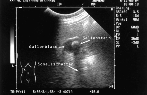 Cholelithiasis_Ultraschall Gallenstein_Sonografie_Gallenstein.png