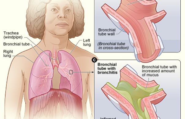Bronchitis1_Bronchitis.jpg