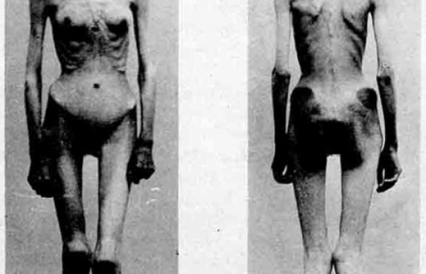 Magersucht1_512px-Anorexia_case_1900.jpg