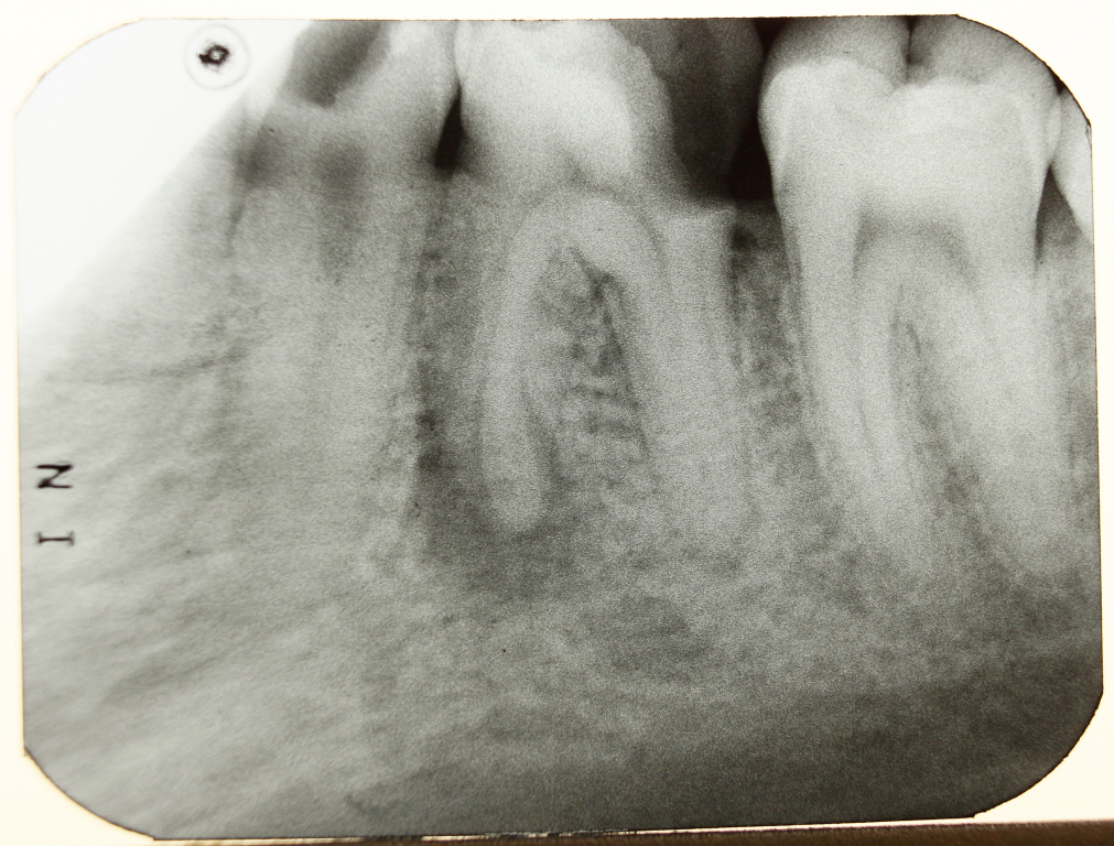 Parodontitis_Zahn_Dental_X-ray_2012_PD_06.JPG