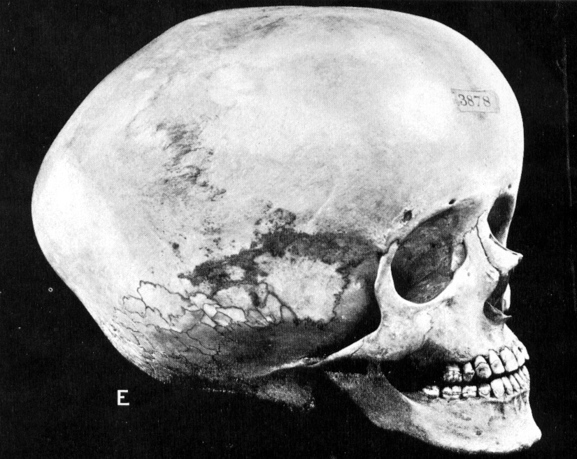 Wasserkopf_Schädel_Hydrocephalic_skull.jpg