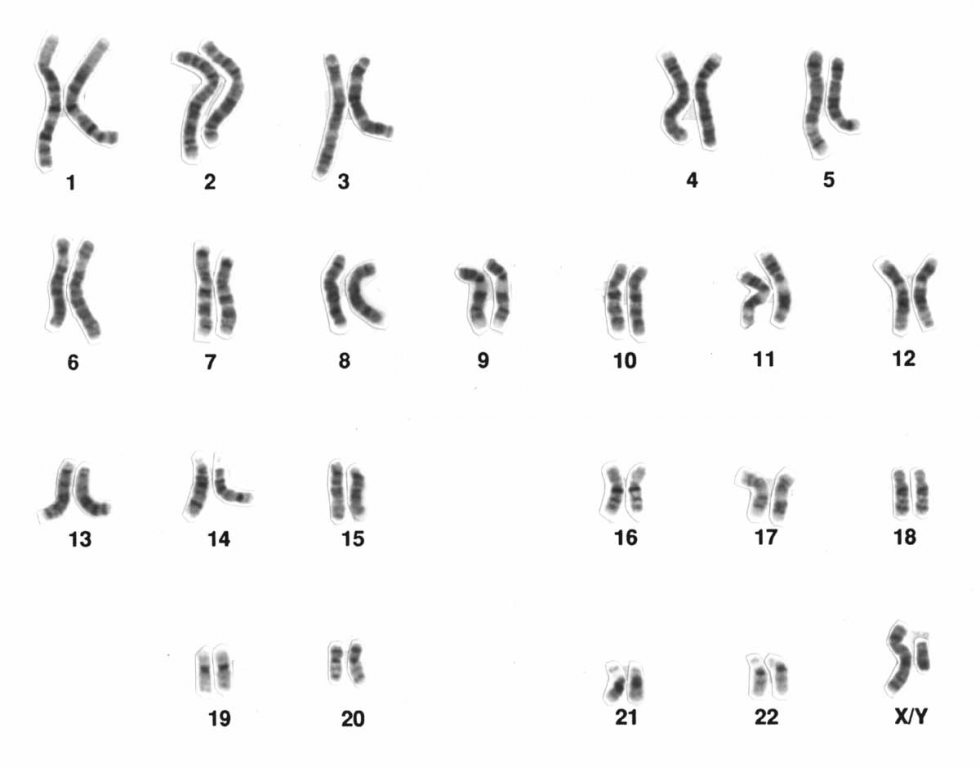 Chromosomenaberration_Human_male_karyotpe_high_resolution.jpg