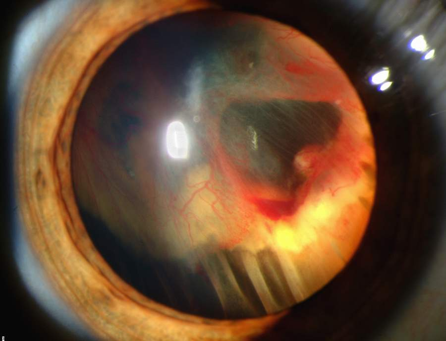 Slit_lamp_photograph_showing_retinal_detachment_in_Von_Hippel-Lindau_disease_EDA08.JPG