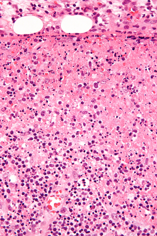 Histiocytic_necrotizing_lymphadenitis_-_very_high_mag.jpg