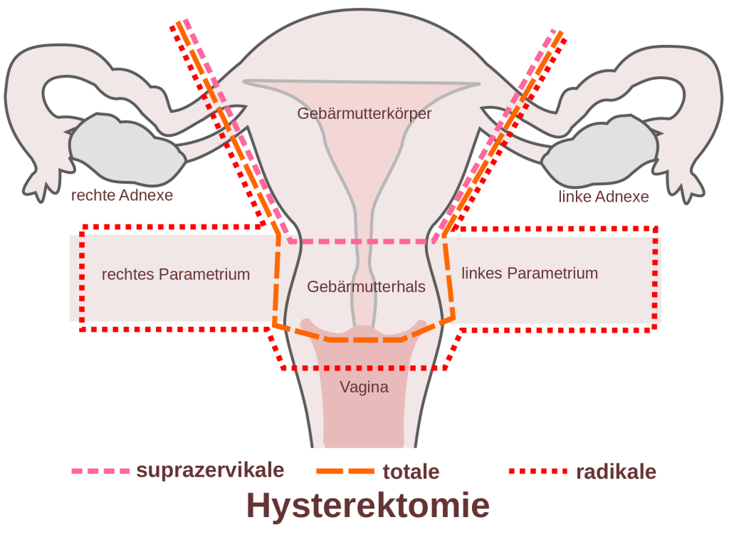 Wechseljahre_Hysterektomie_1024px-Scheme_hysterectomy-de.png